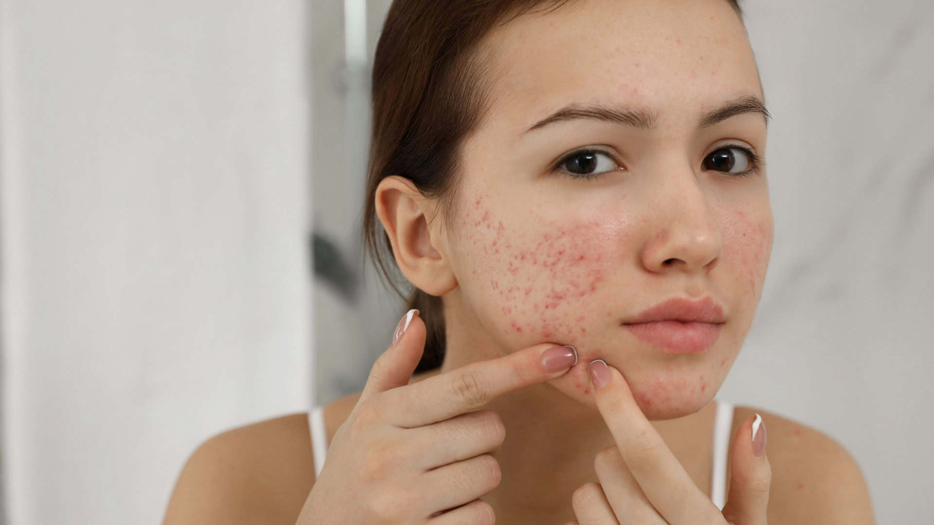 Fim da acne? Vacinas estão a caminho!
